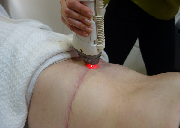 Fraxel laser treatment for scars, skin concerns, wrinkles and lines PLUS healite II