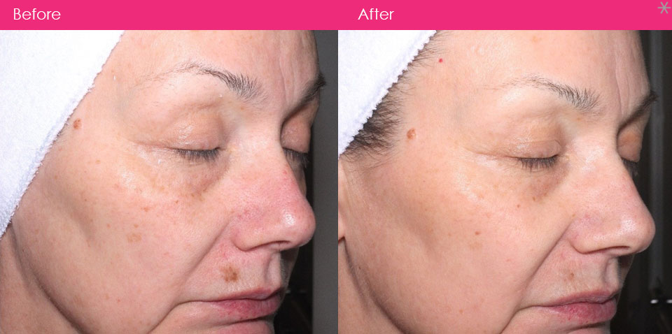 FRAXEL laser skin treatments Melbourne before and after
