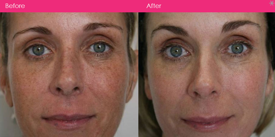 Fraxel laser skin rejuvenation Before and after