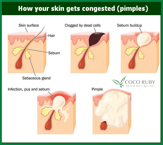 how pimples form