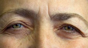 hooded eyelids fixed by blepharoplasty surgery