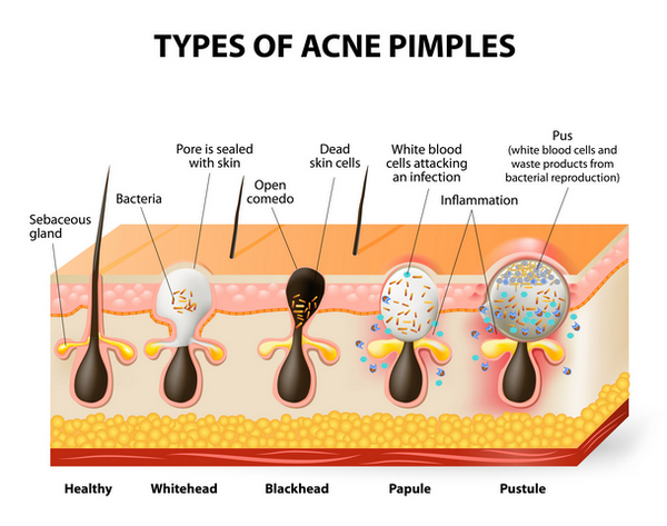 Types of acne pimples. Healthy skin, Whiteheads and Blackheads, Papules and Pustules