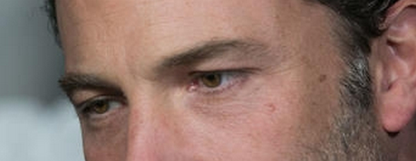 ben-affleck-eyes-celebrity-blepharoplasty