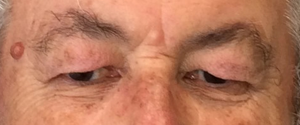 eyelid-ptosis photograph image example of eyelid ptosis condition