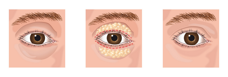 eyelid surgery for ptosis - blepharoplasty surgery-example-inforgraphic