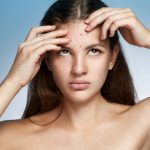 acne and what you eat, acne treatments, acne and diet, acne and nutrtion