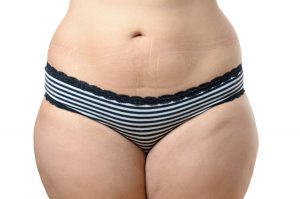 liposuction-thighs-fat-thighs