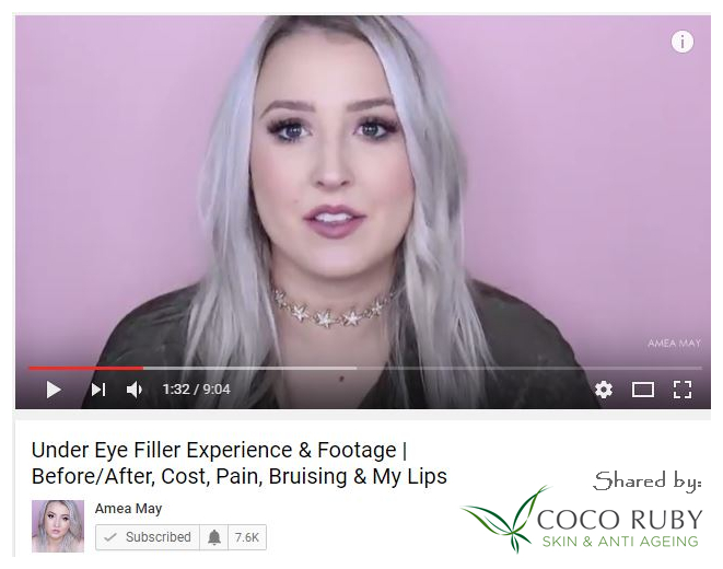under eye dermal filler tear-trough-dermal-filler-injections-under-eyes-video