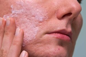 acne worse in summer