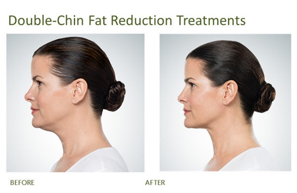 Double chin fat reduction injections neck sculpting