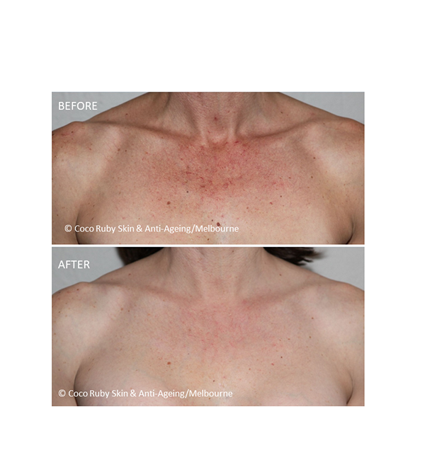 decolletage-laser-ipl-for-sun-damaged-chest